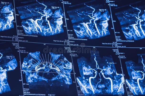 mediumrangeinterceptor中程截击机扫描关于大脑的脑血管,字母x线断层摄影术-字母x-射线关于射弹