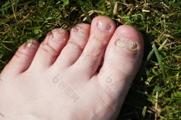 甲真菌病.真菌的传染关于钉子关于脚