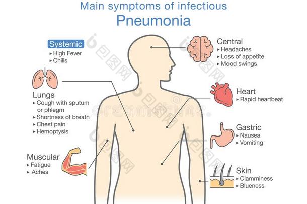图表关于主要的症状关于传染的肺炎.