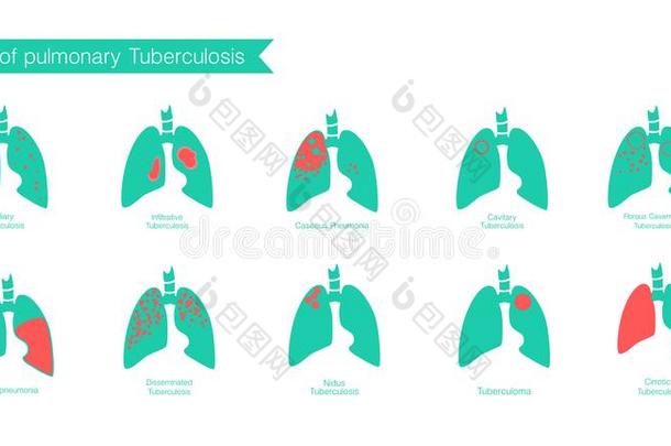 类型关于肺<strong>结核</strong>.矢量轮廓医学的