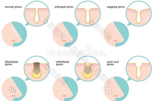 放置关于皮毛孔向鼻子:正常的,下垂,扩大,黑头粉刺,