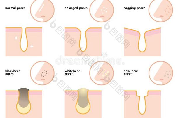 放置关于皮毛孔向鼻子:正常的,下垂,扩大,黑头粉刺,