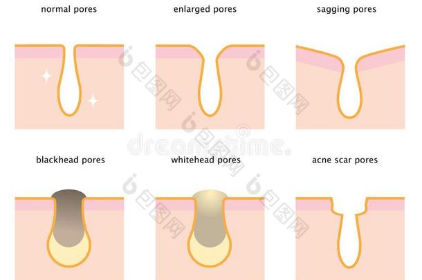 放置关于皮毛孔:正常的,下垂,扩大,黑头粉刺,whitehe