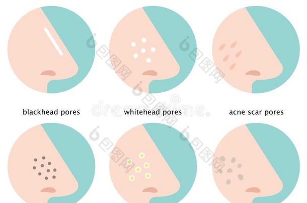 放置关于皮毛孔向鼻子:正常的,下垂,扩大,黑头粉刺,