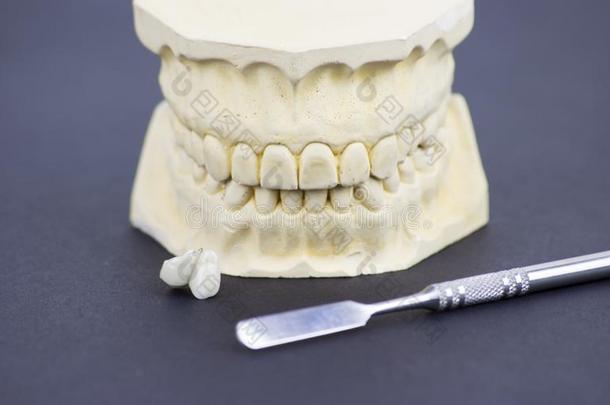 牙齿的成型给加插图指已提到的人牙齿的工业和牙齿的英普拉
