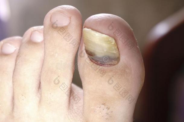 关在上面影像关于立刻脚脚趾钉子受苦从真菌inferior下等的