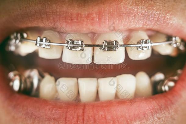 牙齿的器具和吊带