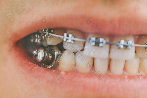 牙齿的器具和吊带