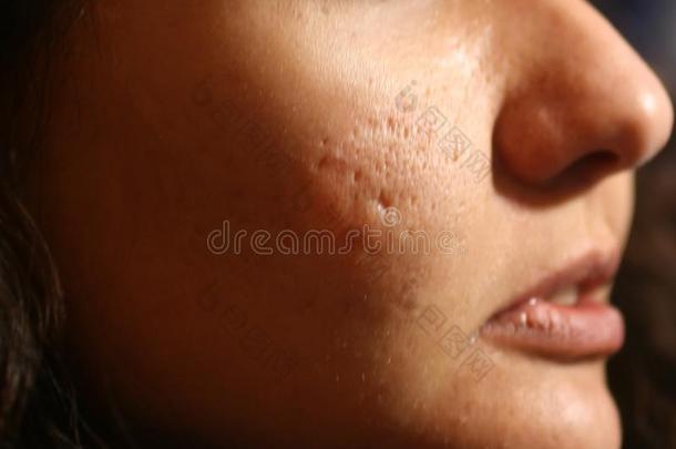 发炎的皮关于指已提到的人面容采用丘疹和痤疮.瘢痕疙瘩伤痕从