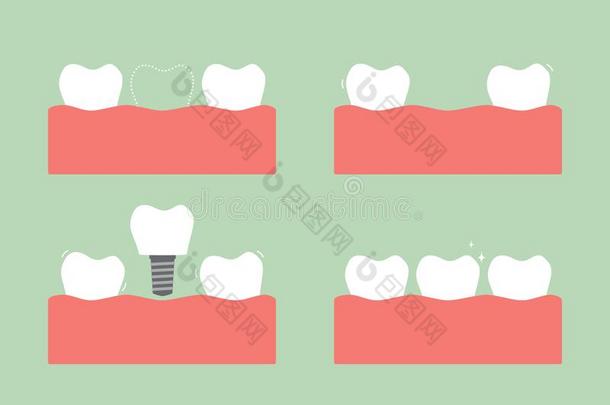 步关于<strong>龋齿</strong>向<strong>牙齿</strong>的移植物和王冠,在之前和后的