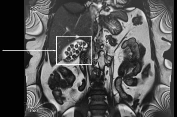 胆汁-石头,胆囊炎.mediumrangeinterceptor中程截击机调查.