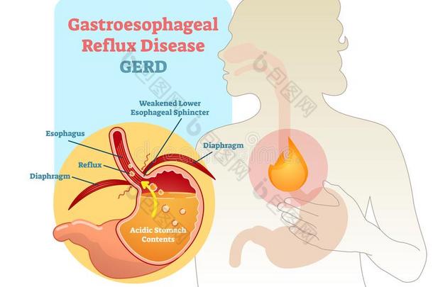 <strong>胃</strong>食管的逆流疾病图表密谋