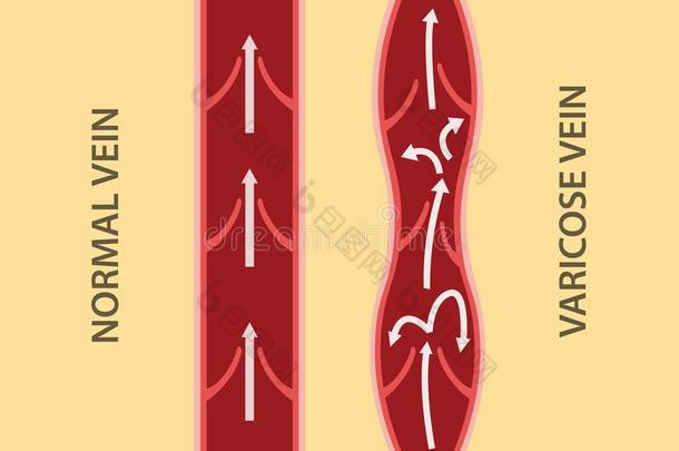 比较比较在之间正常的静脉和曲张的静脉采用森林<strong>中</strong>的<strong>草</strong>木