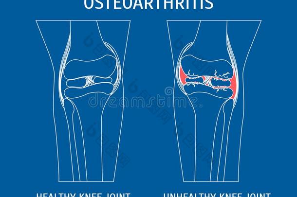 薄的线条骨关节炎健康的和不健康的膝.矢量