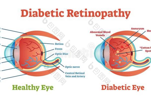 糖尿病的视网膜病矢量说明图表,结构的school学校