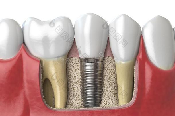 解剖关于健康的牙和牙牙齿的移植物采用人声音