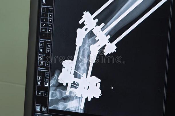 医生有样子的在一字母x-射线采用一hospit一l