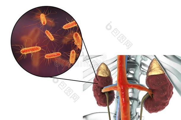 肾盂肾炎,关-在上面看法关于细菌人为的肾依夫拉玛