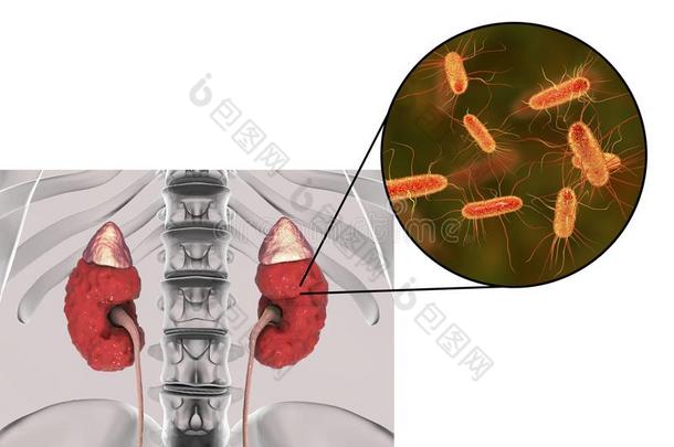 肾盂肾炎,关-在上面看法关于细菌人为的肾依夫拉玛