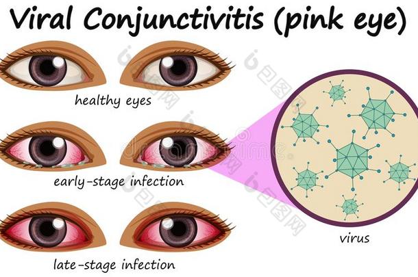 人眼睛疾病和病毒的结膜炎