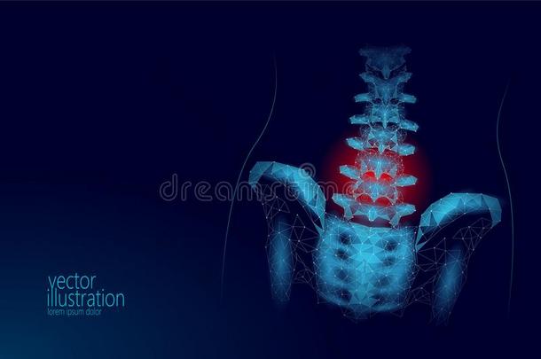 人脊柱臀部腰部的脊神经根炎痛苦低的工艺学校.几何学的工艺学校