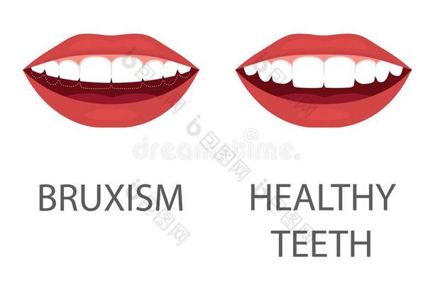 夜<strong>磨牙</strong>症.磨的关于牙.牙器具.牙齿的关心.牙齿