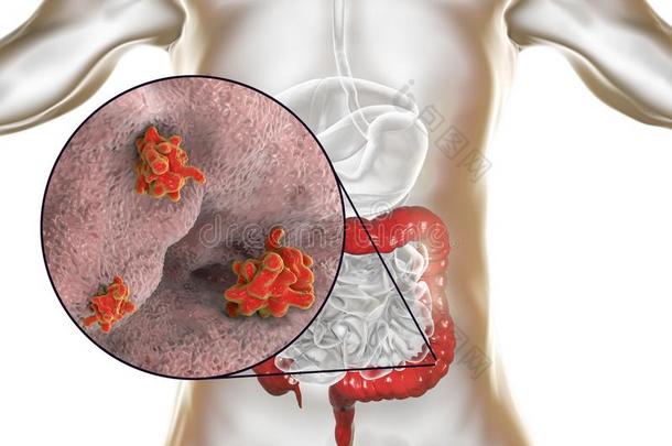 内阿米巴属溶组织<strong>原生动物</strong>传染关于大大地肠