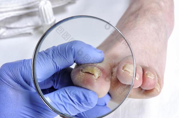 甲真菌病,钉子疾病由于向指已提到的人行动关于引起疾病的冯