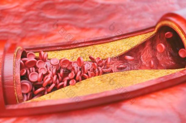 特写镜头关于一一therosclerosis-3英语字母表中的第四个字母翻译