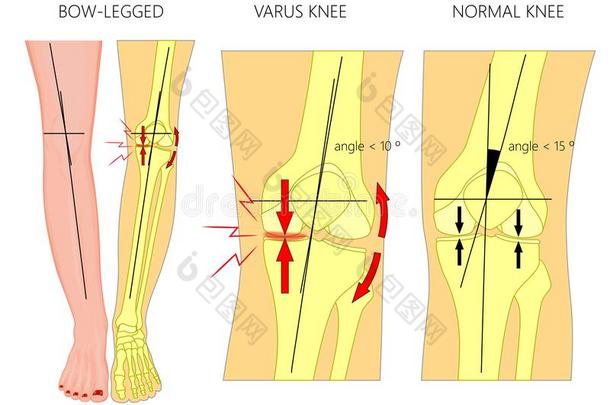 情况关于指已提到的人木头支架.正常的和弧形的木头支架.短促的敲打膝.弯如弓的腿