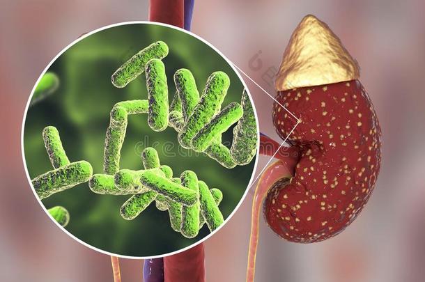 肾盂肾炎,医学的观念,和关-在上面看法关于细<strong>菌</strong>,