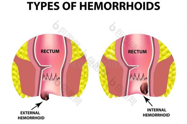 两个类型关于痔疮是外面的和国内的.直肠structural结构上的