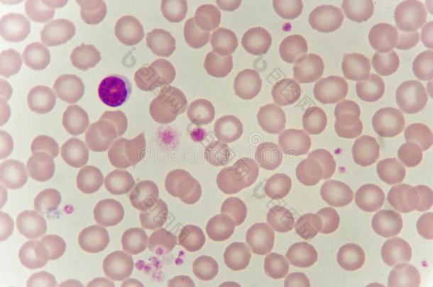 淋巴球细胞采用血涂抹