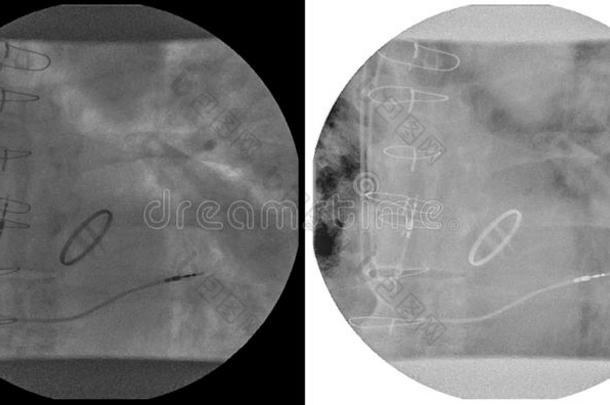 心X光线和两个两个腔领跑者铅片采用左边的心房一