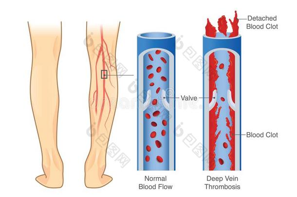 医学的图表关于深的静脉血栓症在腿地区.