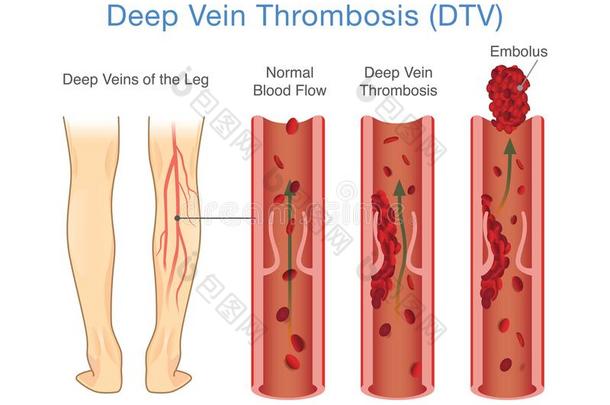 医学的图表关于<strong>深</strong>的<strong>静脉血栓</strong>症在腿地区.