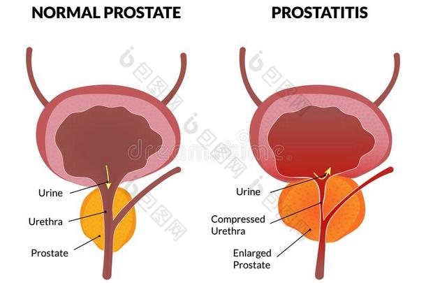 前列腺炎病理海报