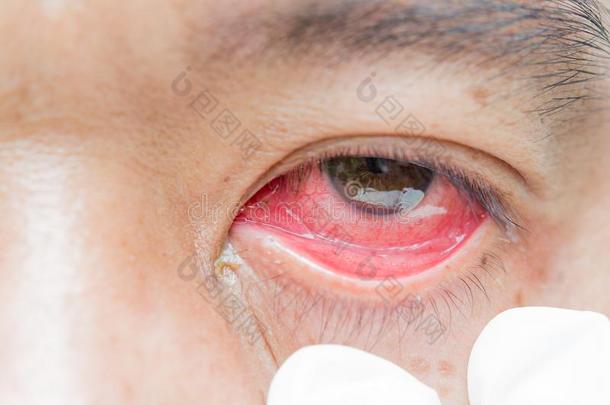 红色的充血的眼睛和传染