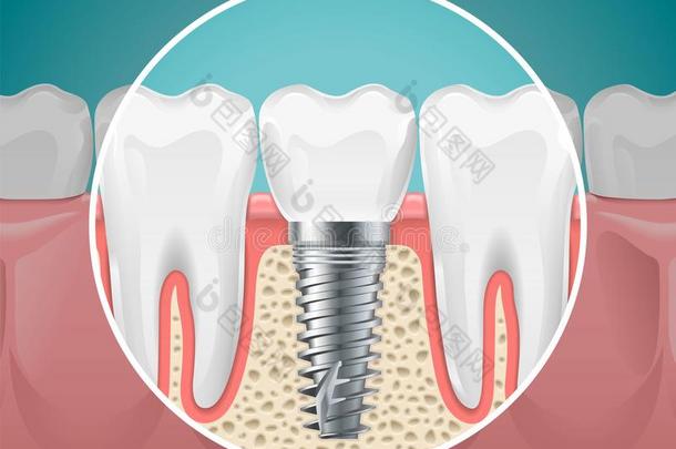 口腔病学插图.牙齿的移植物和健康的牙