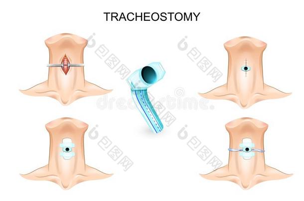 气管造口术.气管造口术管