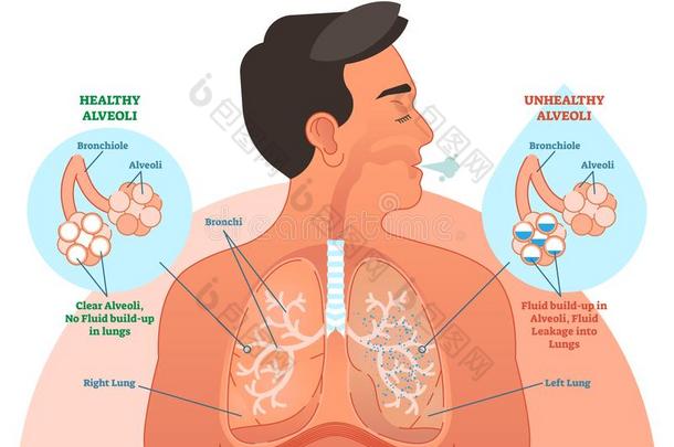 肺的水肿,肺问题矢量说明图表