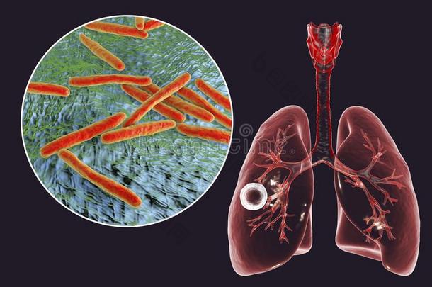 含纤维的-洞穴状的肺的肺结核
