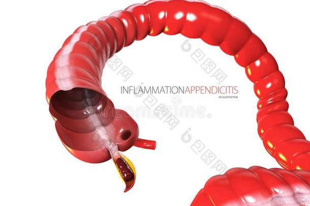 阑尾炎观念,人肠解剖同样地一3英语字母表中的第四个字母illustr一ti