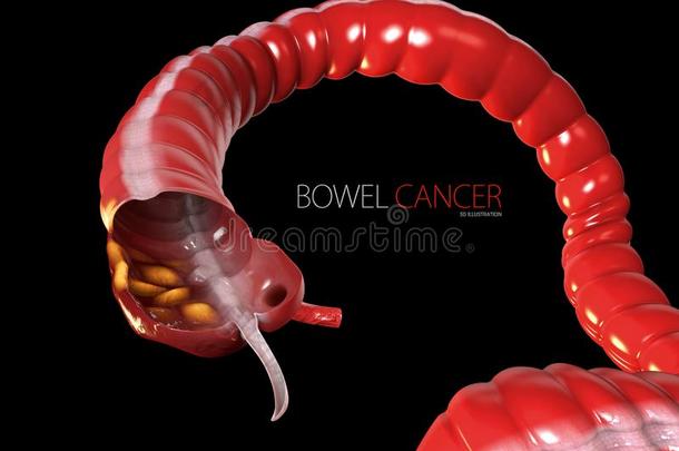 结肠直肠的癌症,隔离的黑的背景3英语字母表中的第四个字母说明