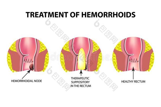 治疗关于痔疮和栓剂.信息图表.vectograp矢量图