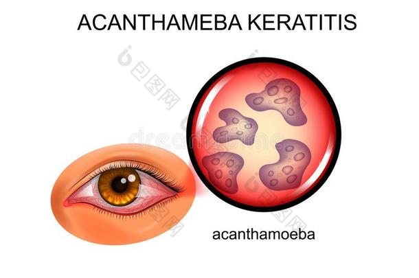 棘阿米巴角膜炎.结膜炎