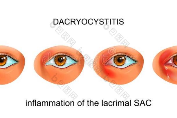 炎症关于指已提到的人泪腺的囊关于指已提到的人眼睛.泪囊炎