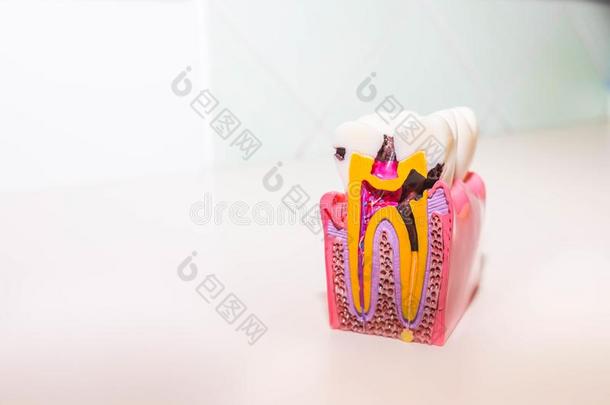 牙模型和龋齿,牙腐烂采用牙科医生`英文字母表的第19个字母办公室.<strong>健康</strong>状况