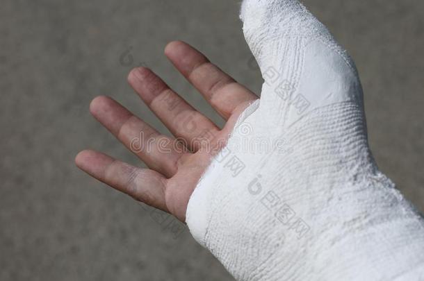 拇指关于指已提到的人折断手关于指已提到的人受伤的和指已提到的人白色的医生