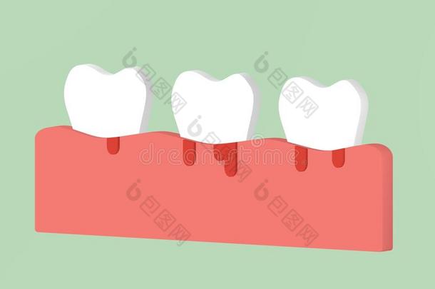 牙周炎或牙齿周围的疾病和流血,炎症